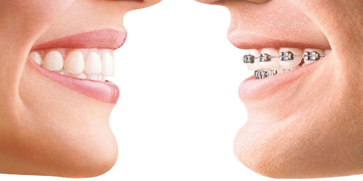 The Benefits of Invisalign Treatment for Teeth Alignment